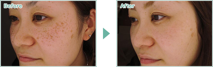 新宿のシミ取りレーザによるしみ治療は 光伸メディカルクリニック 整形外科 美容皮膚科