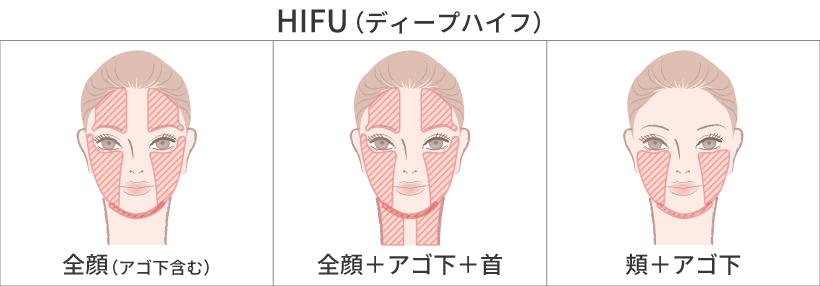 医療HIFU(ハイフ)施術部位