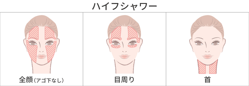 医療HIFU(ハイフ)施術部位