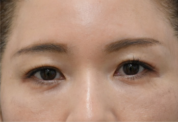 ヒアルロン酸症例写真