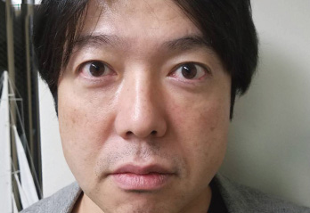 ヒアルロン酸症例写真