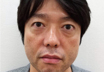 ヒアルロン酸症例写真
