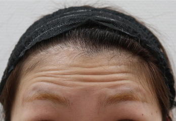 ボトックス注射症例写真