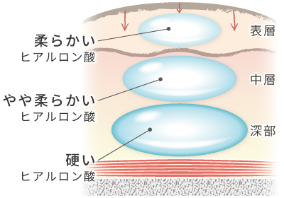 光伸式マルチレイヤーテクニック