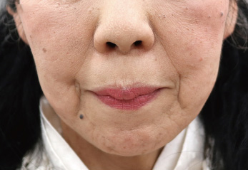 MWデュアルリフト症例写真