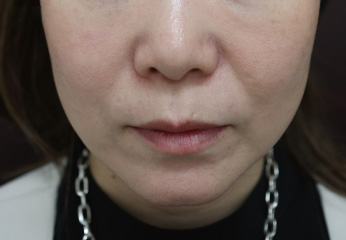 MWデュアルリフト症例写真