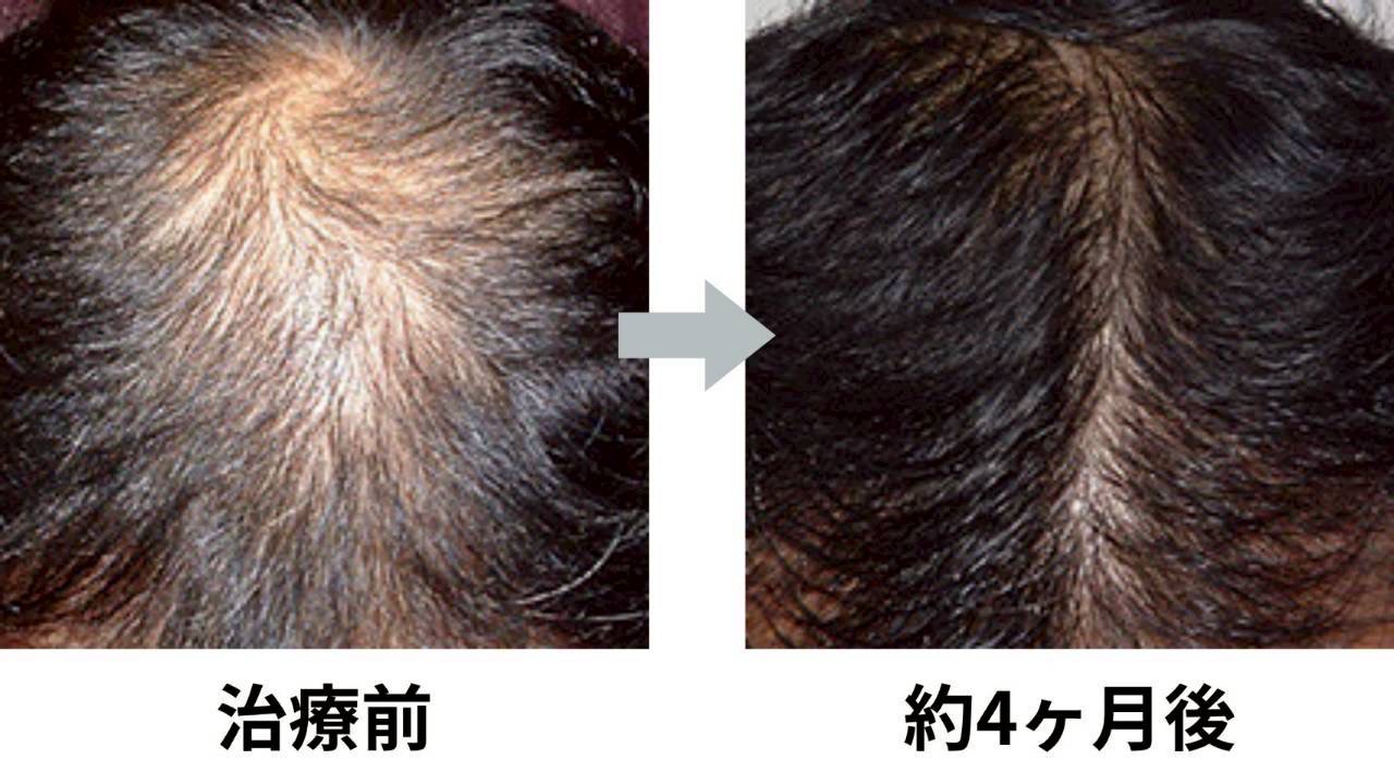 実際にKAMITSU for Manをご使用いただいた患者様